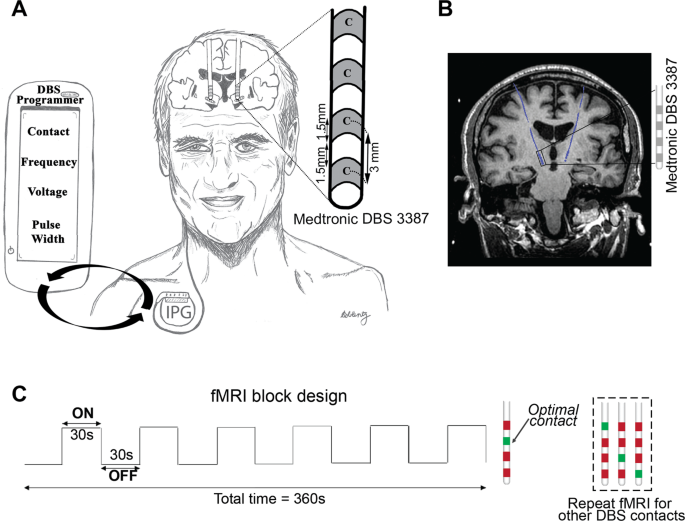 Programmierung der Tiefenhirnstimulation beim Neurologen