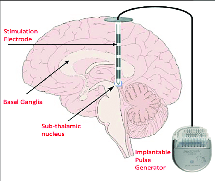 Zielregionen der Tiefenhirnstimulation im Gehirn