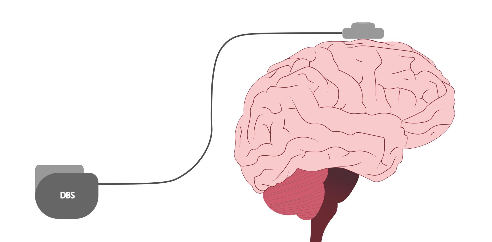 Elektrodenposition bei der Tiefenhirnstimulation