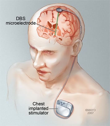 Schema eines DBS-Systems mit Elektroden und Stimulator
