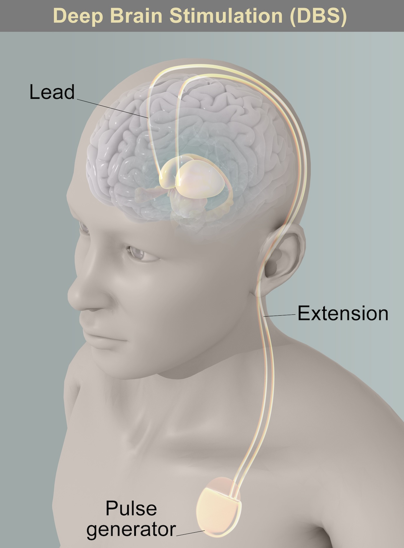 Implantierter Stimulator der Tiefenhirnstimulation im Brustbereich