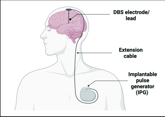 Aufbau eines Hirnschrittmachers bei der THS
